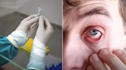 Síntomas de la conjuntivitis: ¿Podrían ser señal de coronavirus?