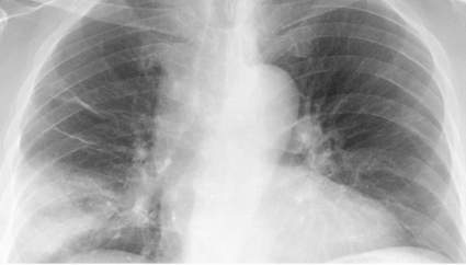 COVID-19: ¿Podría la neumonía ser una complicación severa del coronavirus?