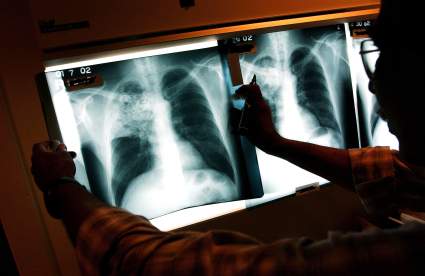 Aumentan casos de tuberculosis en Estados Unidos: ¿Quiénes son los más afectados?