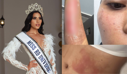 Miss República Dominicana sufre quemaduras tras explosión de olla