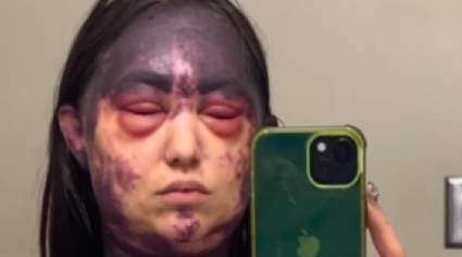 ¿Quién es Alexis Lorenze, mujer sufrió reacción grave a múltiples vacunas?